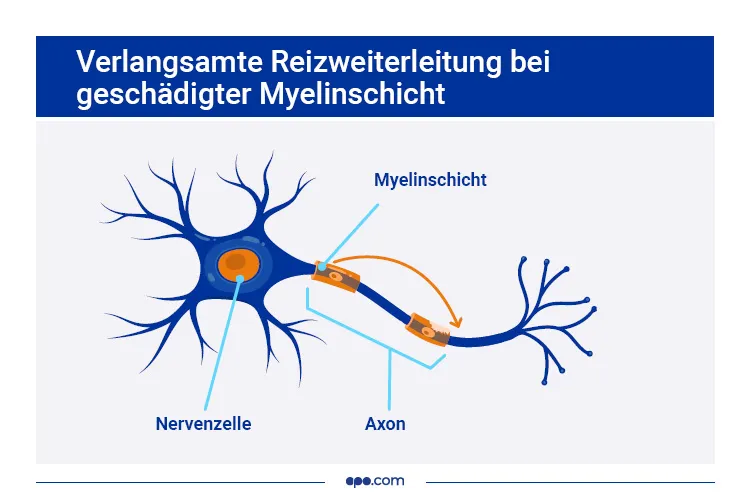 Reizweiterleitung bei kranken Nerven