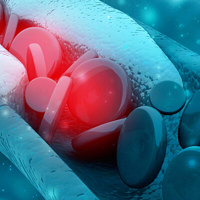 Cholesterin in den Gefäßen