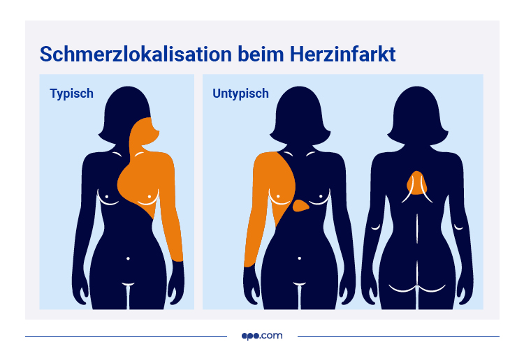 Schmerzlokalisation Herzinfarkt bei Frauen